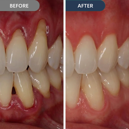 Precision Gum Care Gel