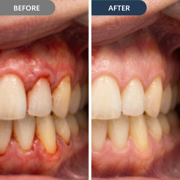 Precision Gum Care Gel